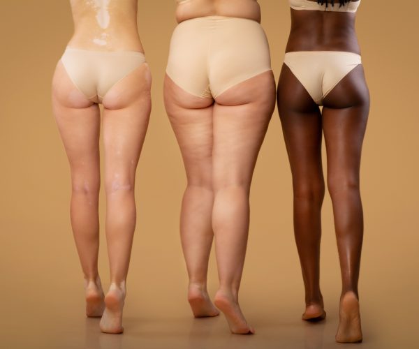 fettreducering, ta bort celluliter